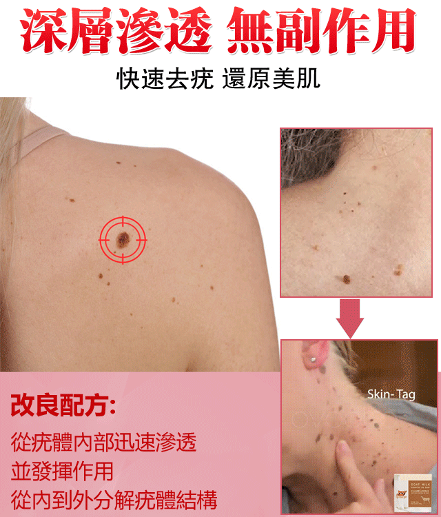 山羊奶去疣精油皂無需手術 衹需一洗輕鬆解决問題 山羊奶去疣精油皂無需手術 衹需一洗輕鬆解决問題